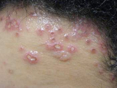 Herpetic Lesions